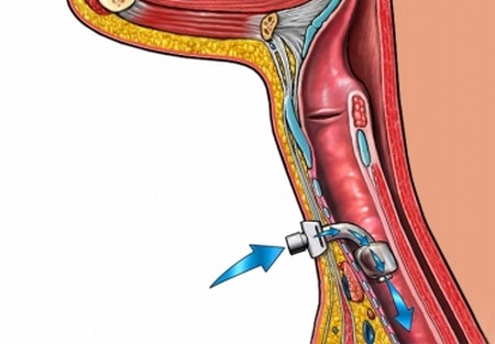 ตำแหน่งท่อหลอดลมคอ