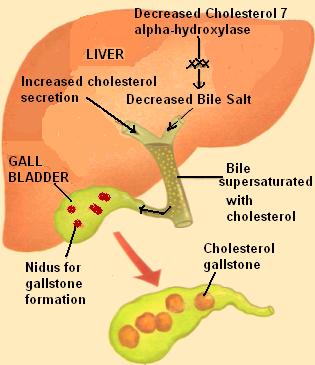 gallstone2.jpg